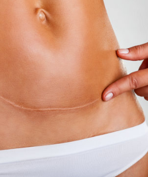 Woman with Skin Scar on belly seeking for Treatment at Aestique Plastic Surgery