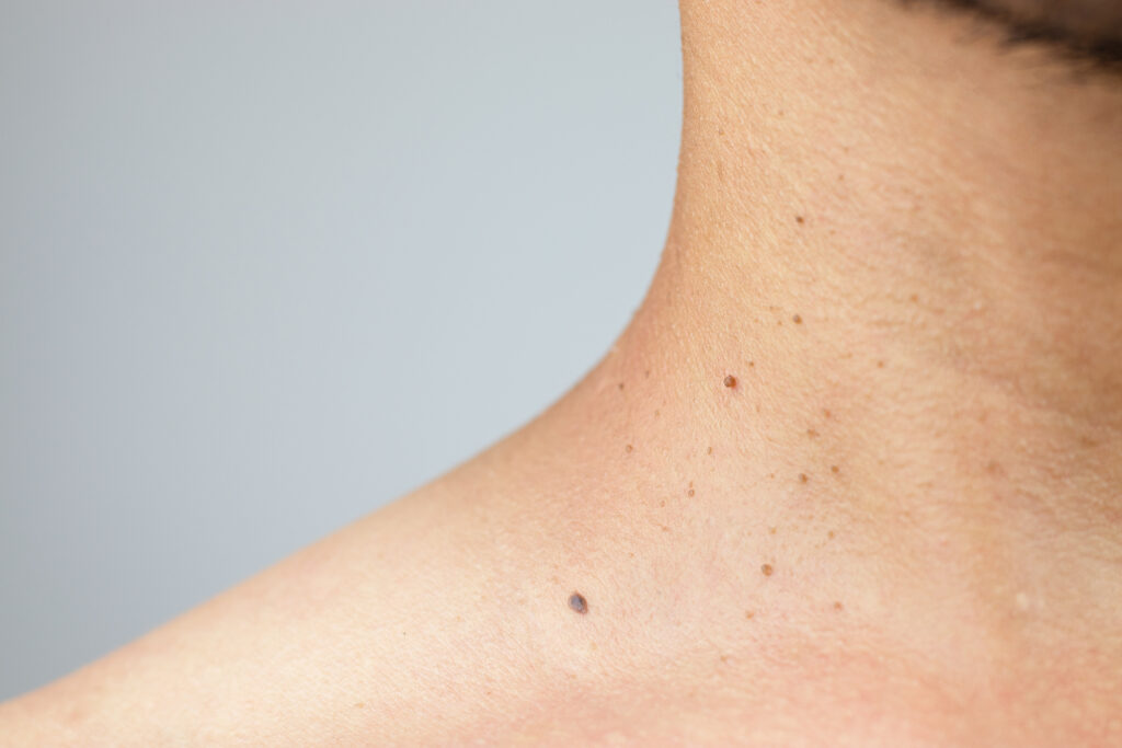 Lesion Removal for Men in Warrendale, PA