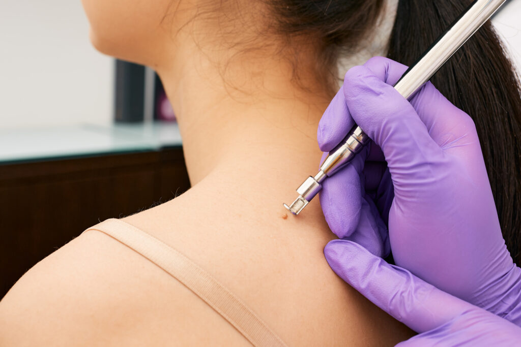 Closeup of Lesion Removal Procedure at Aestique