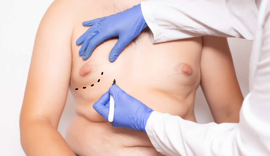 Gynecomastia (Male Breast Reduction) in Wexford PA