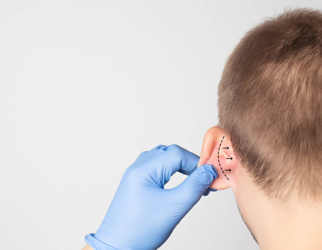 Otoplasty (Ear Surgery) in Greensburg, PA