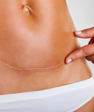 Lady showing scar at belly seeking for treatment in Pittsburgh | Aestique Plastic Surgery