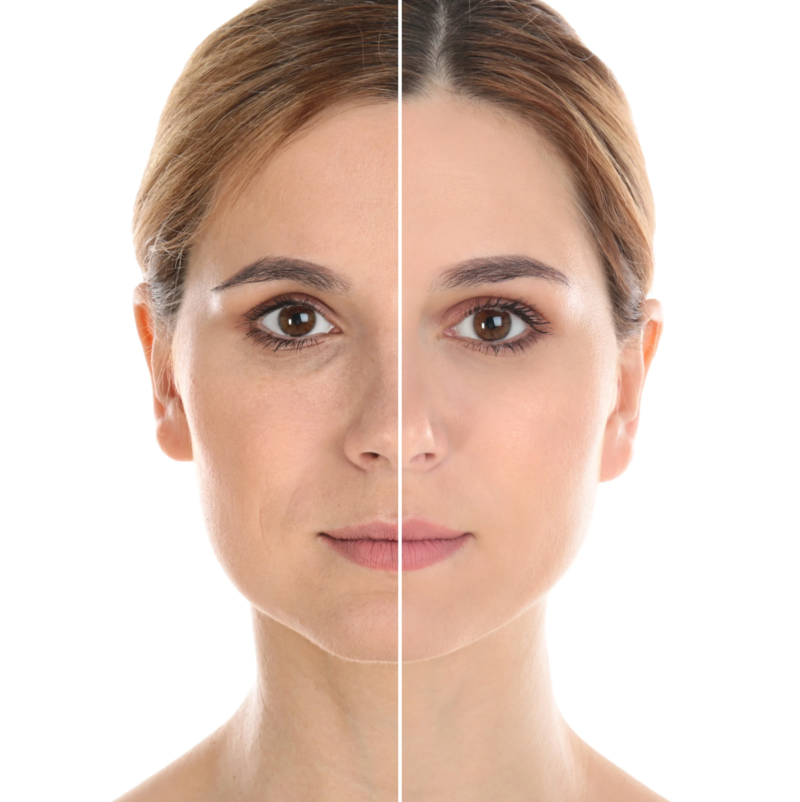 Facial Rejuvenation with Fat Transfer by Aestique Plastic Surgery