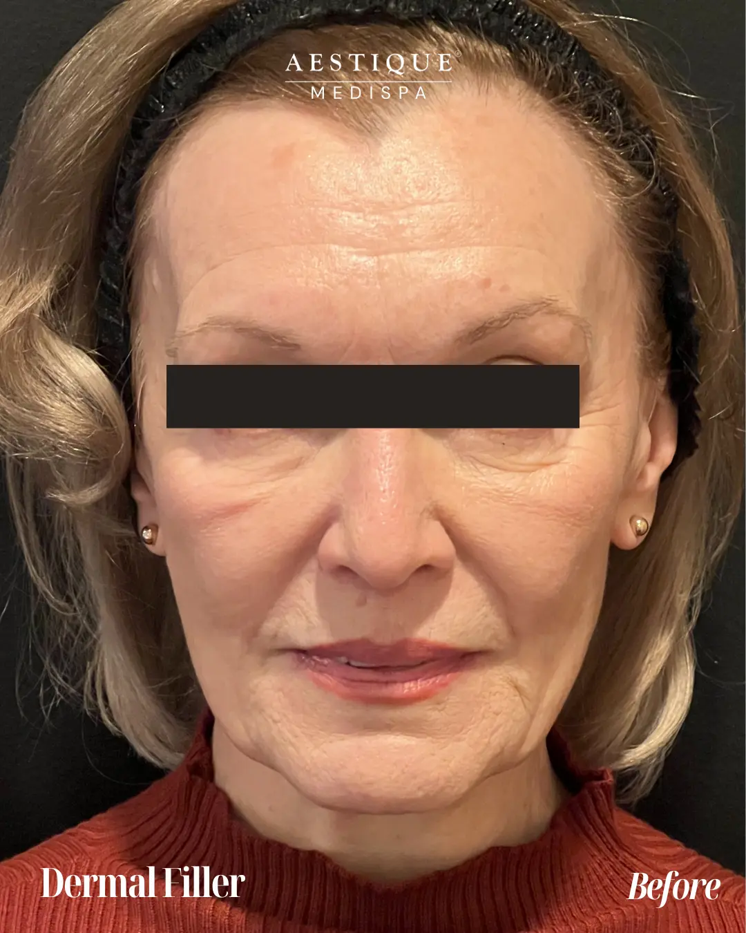 Dermal-Filler-front