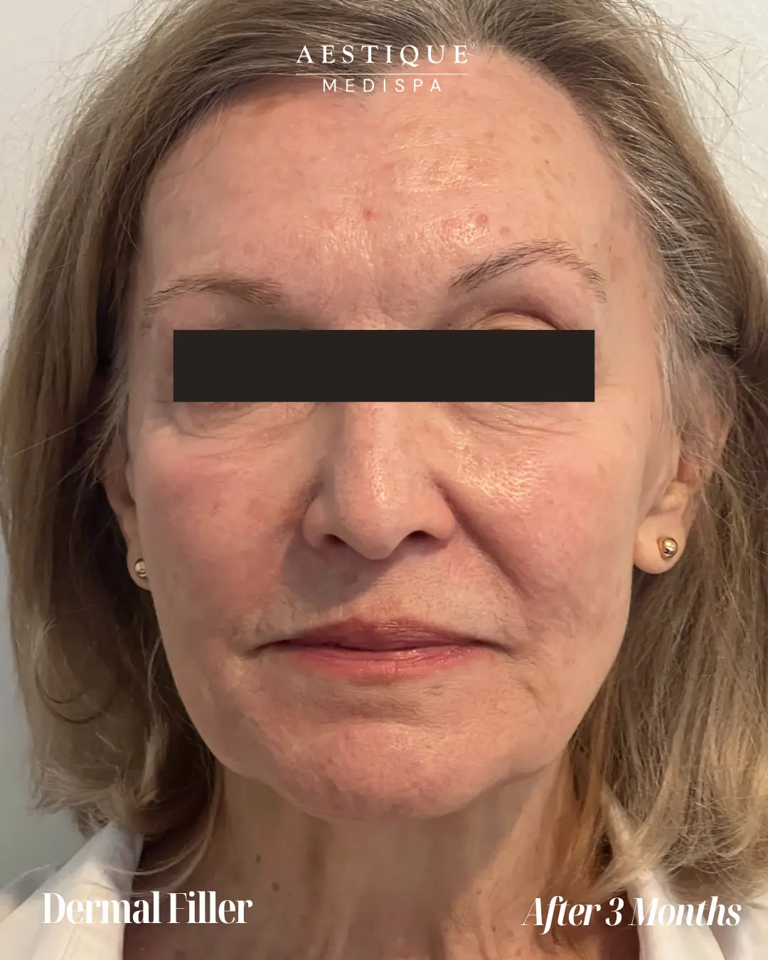 Dermal-Filler