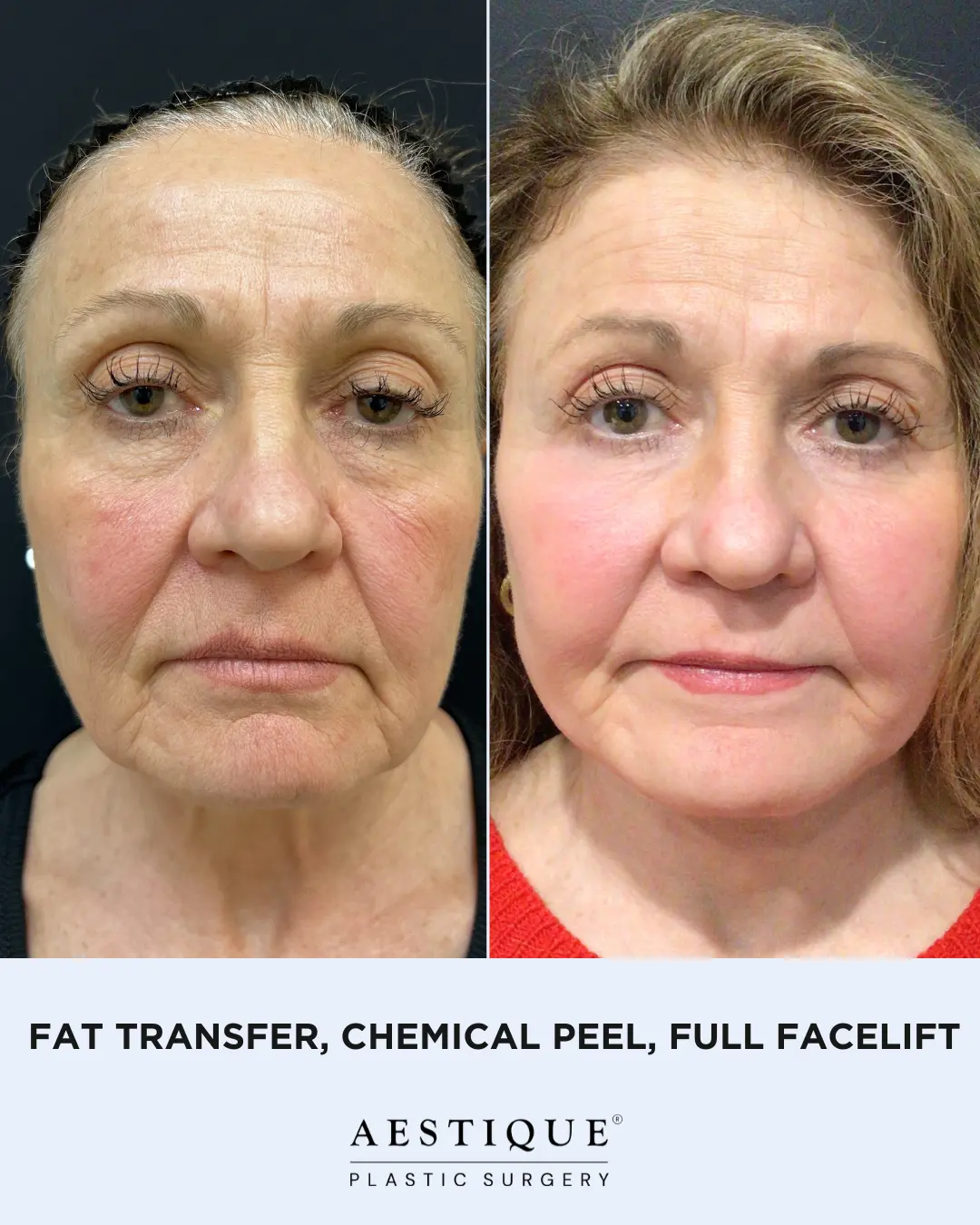 Fat Transfer, Chem Peel, Full FL