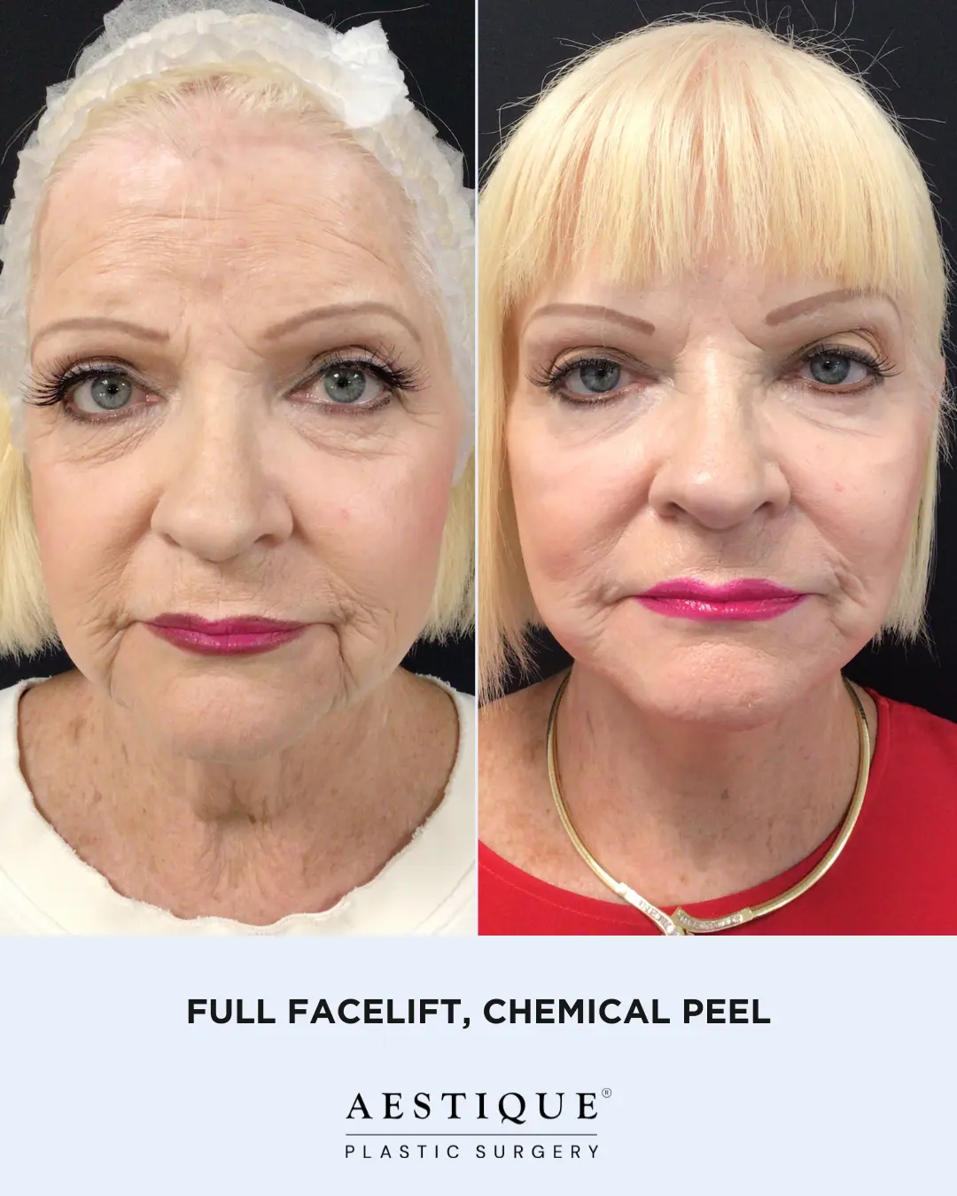 Full Face, Chem Peel
