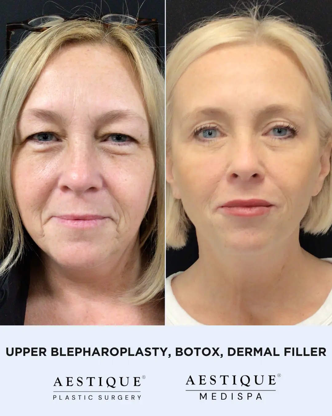 Upper Bleph, Botox, Filler