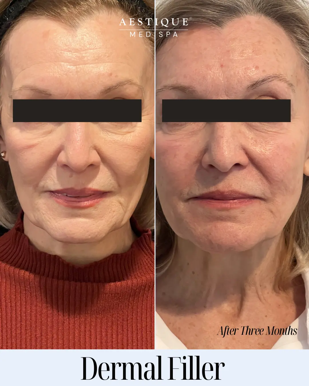 dermal-filler-compare